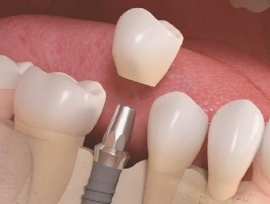 ADENTAL implantologia i estetyka