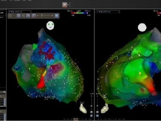 Akcja Ablacja - nowy program edukacyjny dla pacjentów kardiologicznych