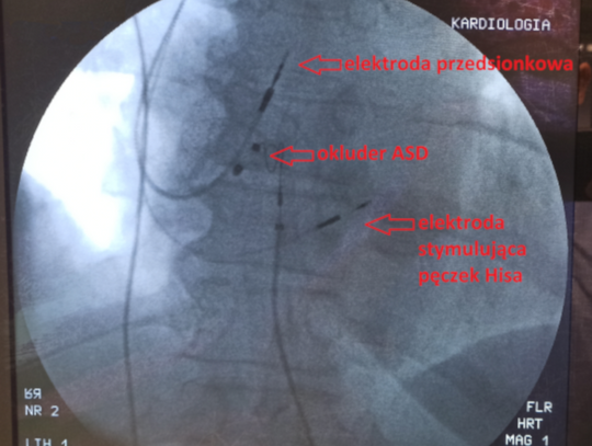 Nowatorska stymulacja serca we wrocławskim szpitalu