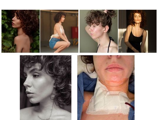 Wiktoria ze Skrzypnika walczy z rakiem tarczycy