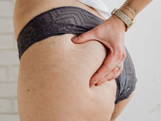 Wyjątkowe właściwości naszej skóry. Skąd bierze się cellulit, zmarszczki czy rozstępy?