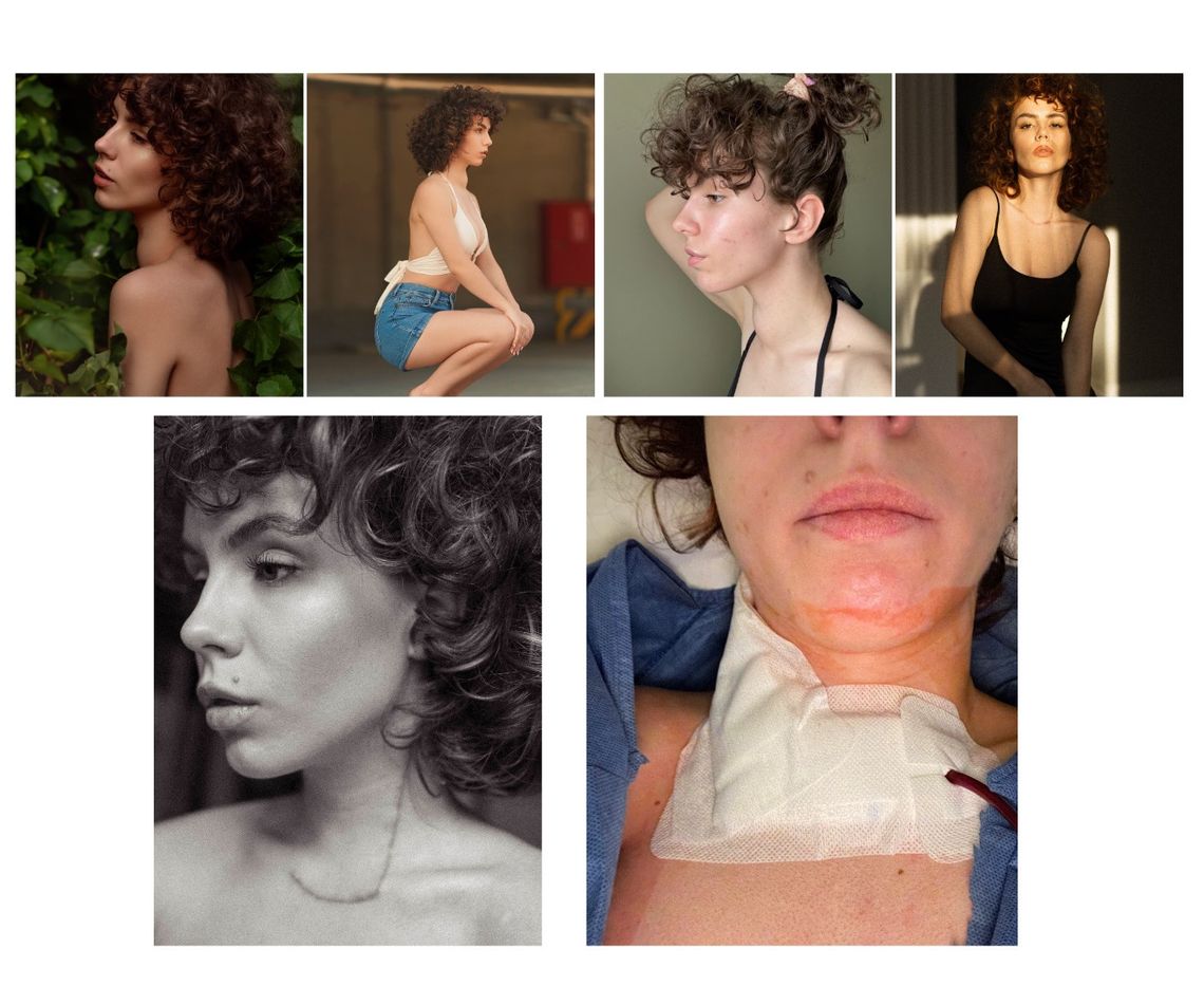 Wiktoria ze Skrzypnika walczy z rakiem tarczycy Wiktoria ze Skrzypnika walczy z rakiem tarczycy